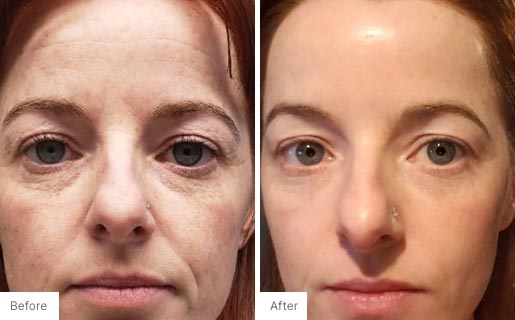 4 - Before and After Real Results image of a woman's face.